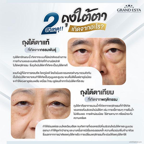 2 สาเหตุ!! ถุงใต้ตาเกิดจากอะไร??